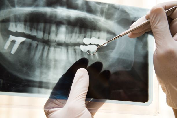 dentist examining a wisdom tooth x-ray while holding dental tool
